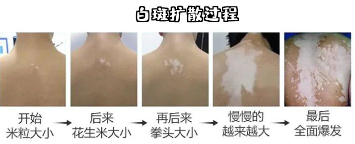 南阳看好白癜风需要多少钱？_南阳白癜风医院——河南治疗白癜风权威医院(图1)