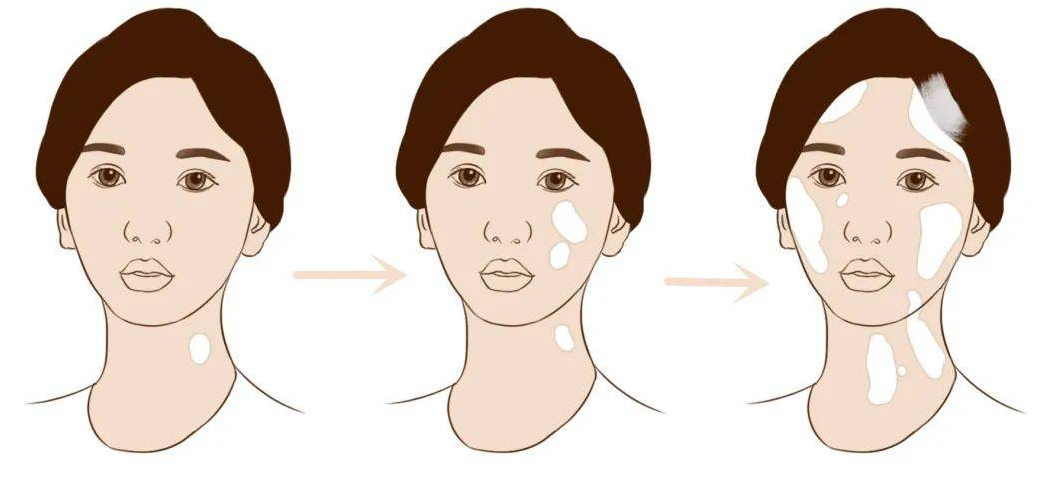 如何鉴别白癜风病情？(图1)