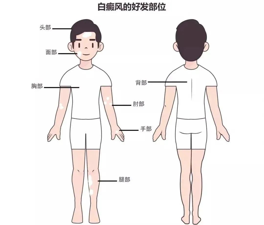 白癜风在哪些部位难以医治？(图1)