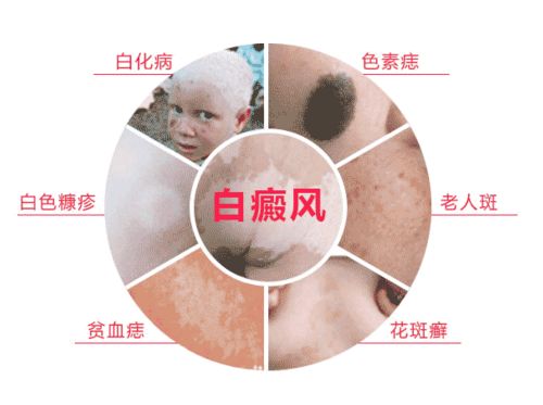 「南阳白癜风医院的曝光」肢端型白癜风应该如何治疗？(图1)