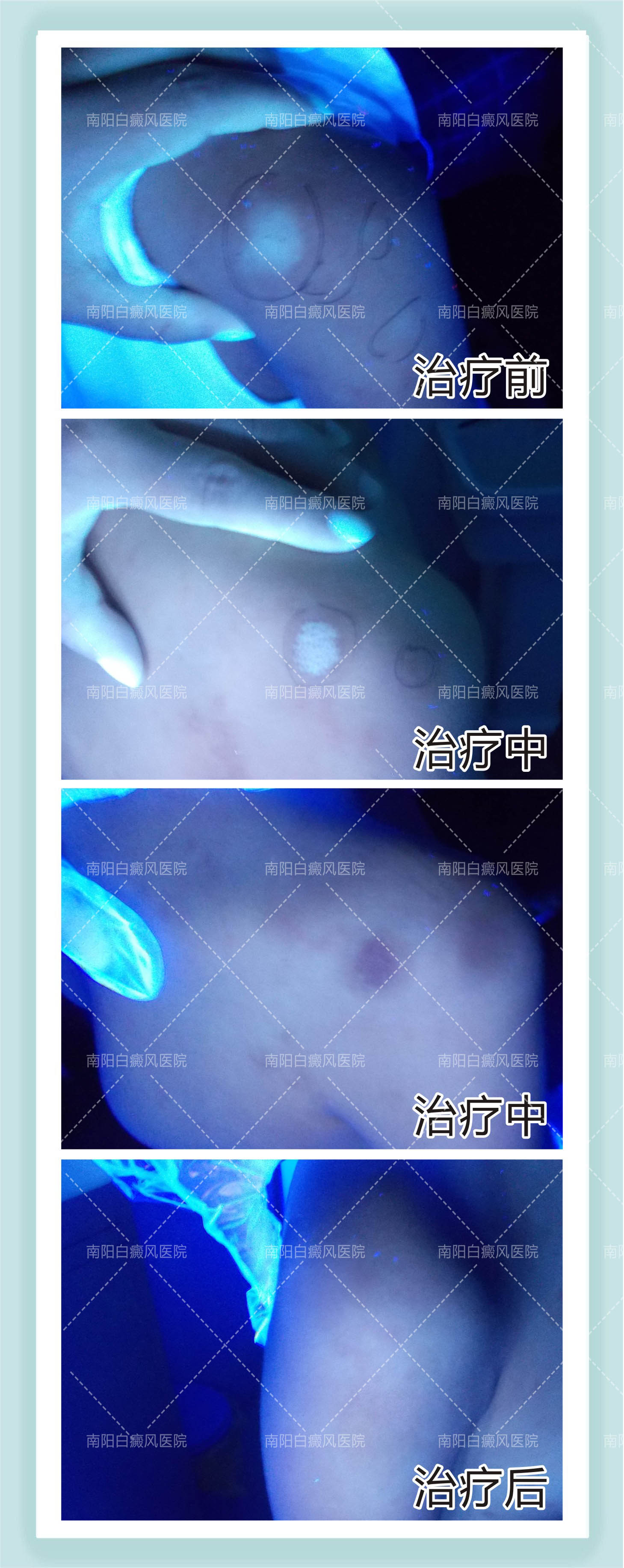 南阳白癜风医院-白癜风会给患者带来哪些坏处？(图1)