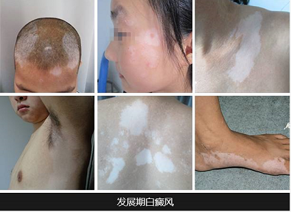 白癜风与护肤：科学护理保护皮肤屏障——南阳白癜风(图1)