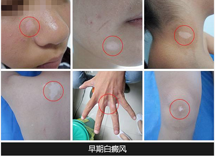南阳白癜风医院-白癜风患者的自我管理与长期康复计划(图1)