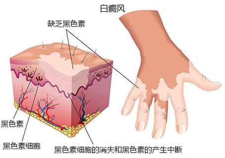 南阳白癜风医院排名-白癜风标准治疗方法！(图1)