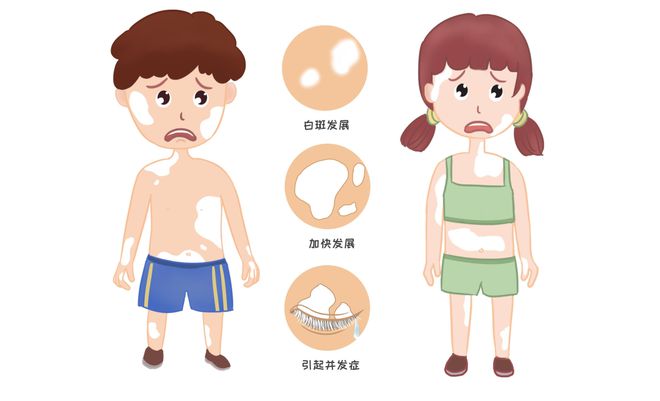 南阳白癜风医院-立夏白癜风患者如何做好防晒？(图1)