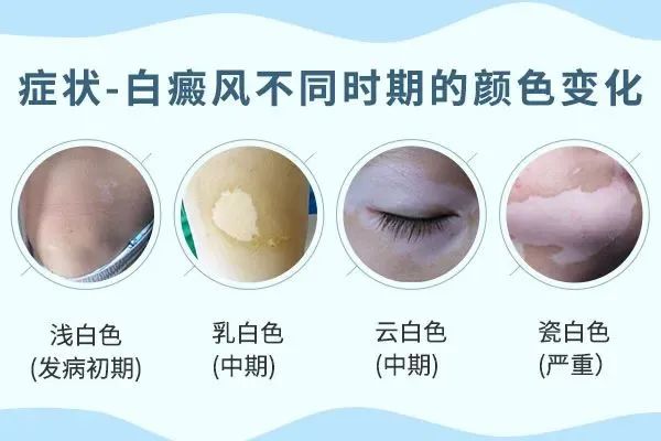 强推！南阳白癜风专科医院-孕妇治疗白癜风都有哪些风险？哪些药物是孕妇治疗白癜风不能用的？(图1)
